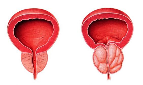 Prostată normală și inflamată (prostatita)